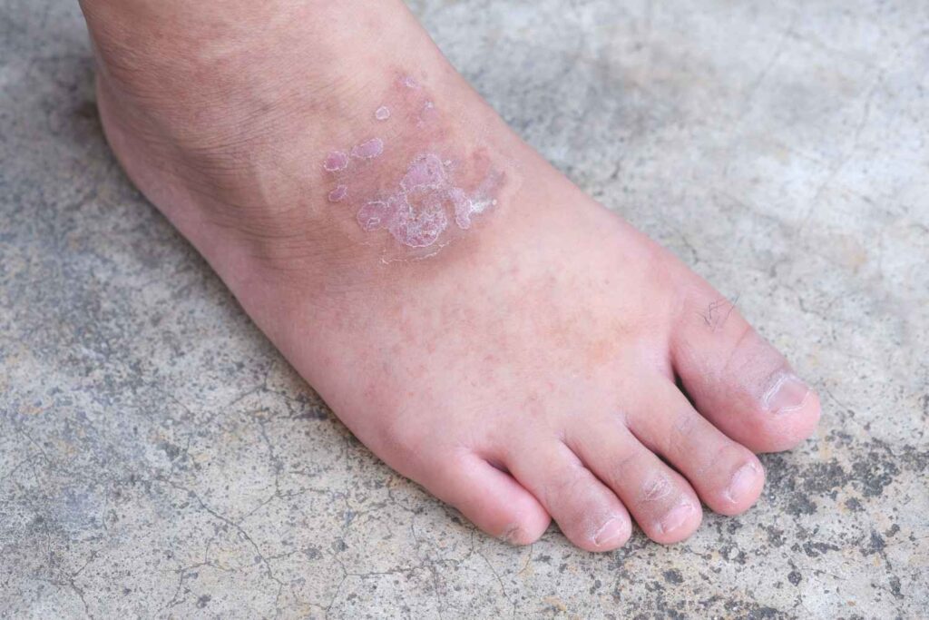 wound healing
